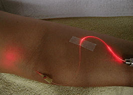Внутривенное лазерное облучение крови (влок)